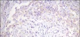 Immunohistochemical diagnosis of breast cancer receptor status (PR, ER, ki67, Her2 neu)