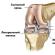 Lezarea meniscului articulației genunchiului
