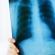Gon'un akciğerlerdeki lezyonu: nedir, tanı ve sonuçları Akciğer tüberkülozunun sonuçları ve komplikasyonları